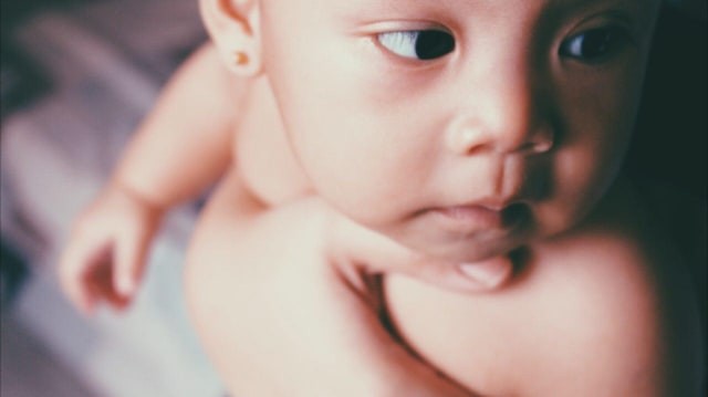 Ciri-ciri Vitiligo pada Bayi (471770)