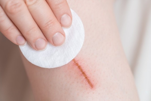Ilustrasi luka yang berdarah karena kurangnya jumlah trombosit di dalam tubuh. Foto: Freepik.com