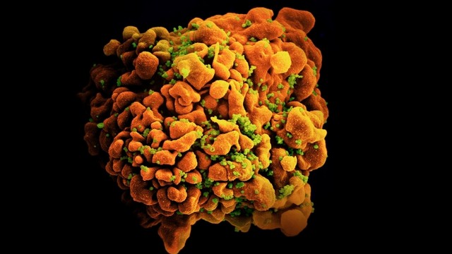 Sel imun yang terinfeksi HIV. Foto: NIH/NIAID