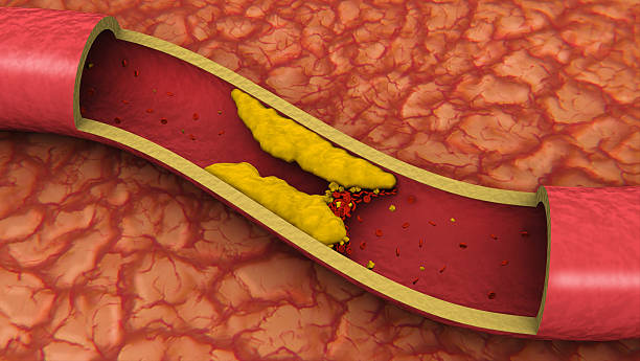 Kolesterol tinggi adalah kondisi ketika terjadinya penumpukan lemak dalam darah yang berlebihan. Foto: Unsplash.com