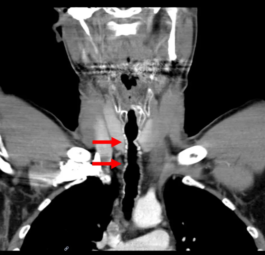 Gara-gara Sering Merokok, Rambut Tumbuh di Dalam Tenggorokan Pria Ini - kumparan.com
