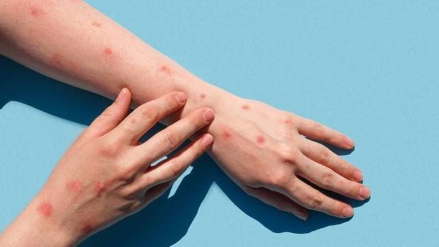 Warga Sumsel Diminta Waspada Virus Npox Seperti COVID-19 - kumparan.com