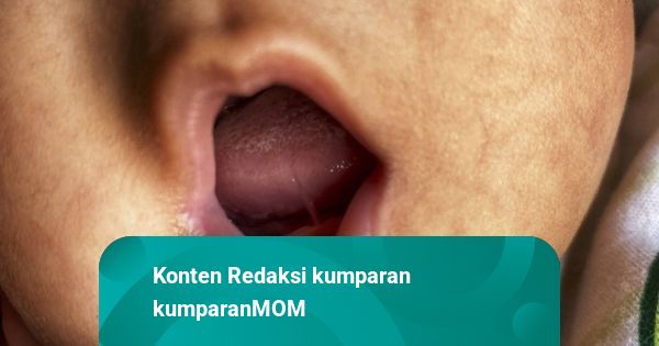 Tongue Tie pada Bayi, Tidak Semua Butuh Tindakan Insisi Bedah!