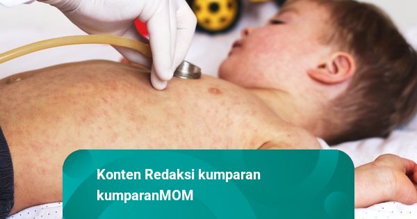 IDAI: Tingkat Penularan Campak Lebih Tinggi dari COVID-19!
