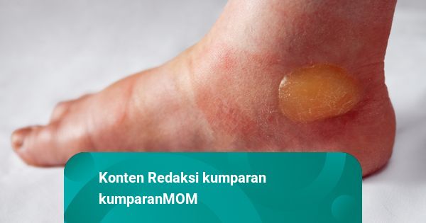 Kata Dokter soal Cara Tepat Menangani Luka yang Bernanah