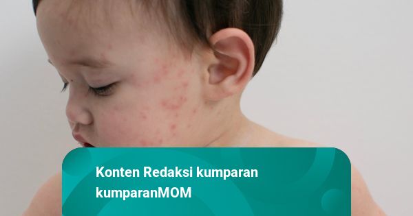 Risiko Campak pada Anak: Tidak Ada Perbedaan Disabilitas dan Non-Disabilitas