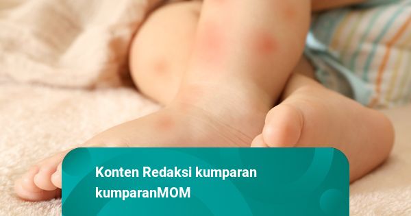 Kenapa Bekas Gigitan Nyamuk di Kulit Bayi Susah Hilang?