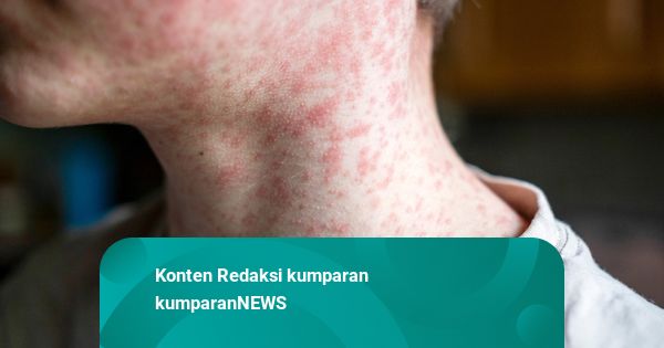 Kemenkes Tegaskan Campak Bukan Varian Baru