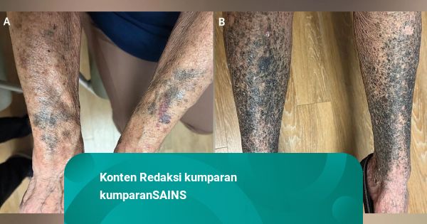 Kulit Wanita Ini Menghitam Setelah Minum Obat Antibiotik buat Rosacea