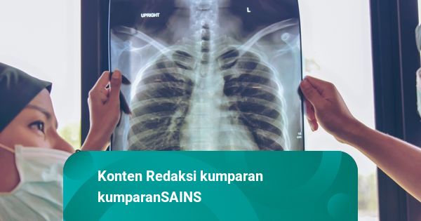 Ilmuwan Temukan Hubungan Antara Pola Makan dan Kanker Paru-paru