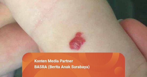 Mengenal Tanda Lahir Warna Merah, Apakah Membahayakan? | kumparan.com