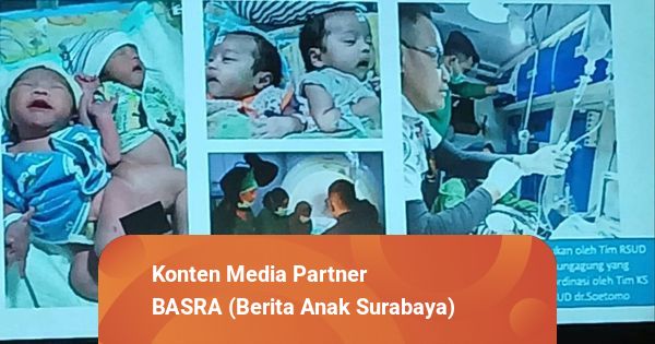 Operasi Berlangsung 9 Jam, Bayi Kembar Siam Asal Tulungagung Berhasil Dipisahkan