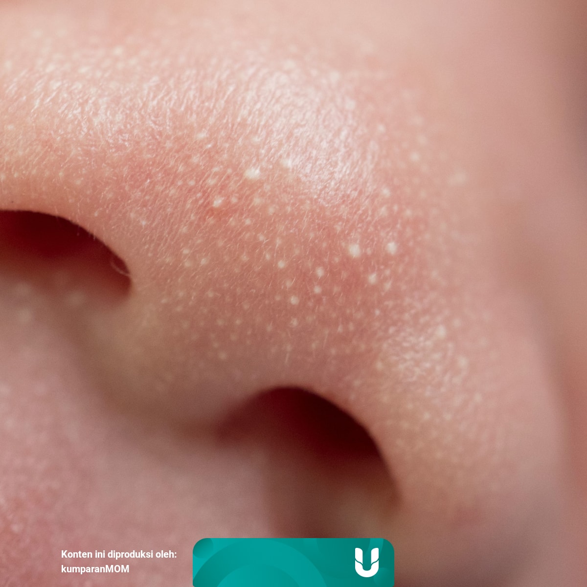 Muncul Bintik Putih Di Wajah Bayi Bahaya Enggak Sih Kumparan Com Kondisi benjolan putih ini adalah kista kecil yang sering muncul di pipi, hidung, mata. muncul bintik putih di wajah bayi