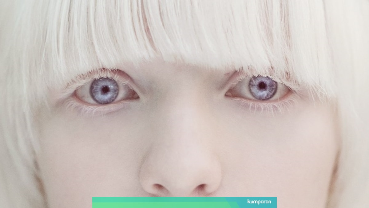 Fakta Fakta Albino Yang Seharusnya Anda Ketahui Kumparan Com