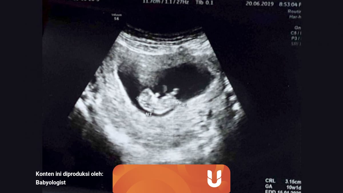 Gambar Hasil Usg Janin Perempuan - Ciri Ciri Bayi Laki ...
