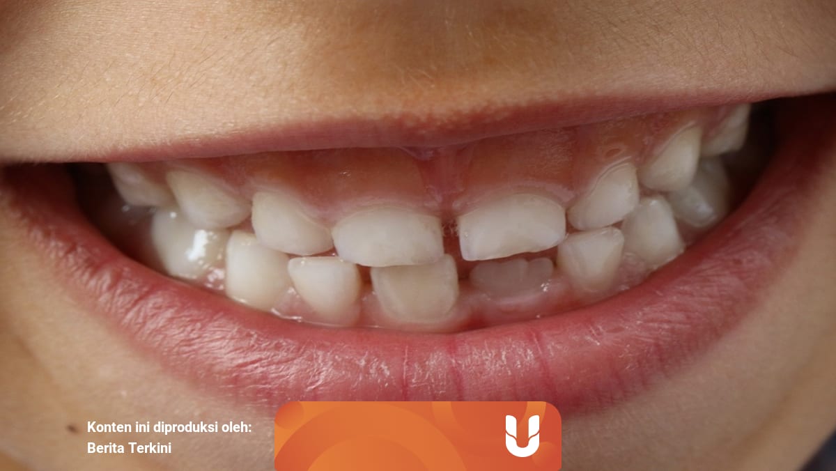 Arti Mimpi Gigi Copot Bagian Bawah Menurut Islam Primbon Dan Psikolog Kumparan Com