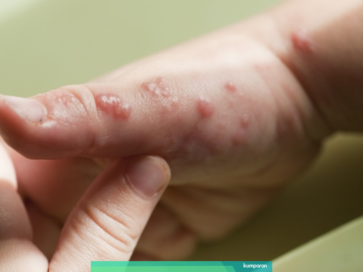 Kulit Anak Melepuh Waspadai Gejala Impetigo Moms Kumparan Com