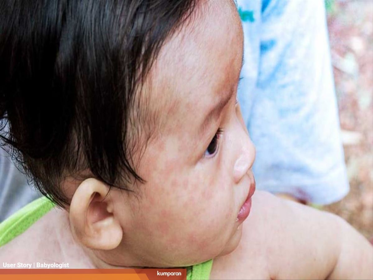 Ikuti 6 Cara Pengobatan Campak Ini Untuk Kembalikan Keceriaan Si Kecil Kumparan Com