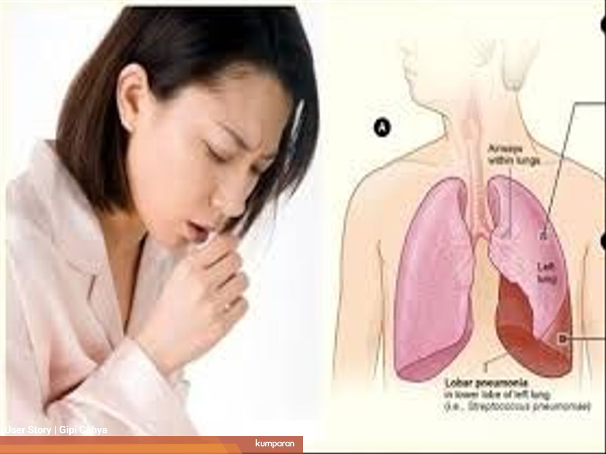 Obat Tbc Paru Kronis Yang Ampuh Dan Tanpa Efek Samping Kumparan Com
