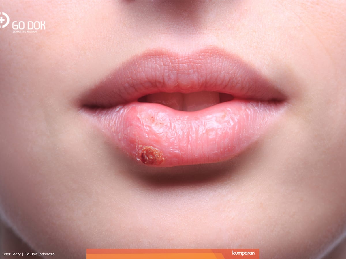Faktor Yang Menjadi Penyebab Munculnya Jerawat Di Bibir Kumparan Com