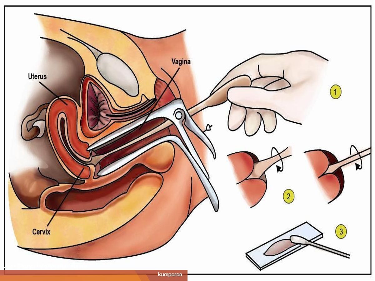Penjelasan Soal Pap Smear Gratis Atau Berbayar Kumparan Com