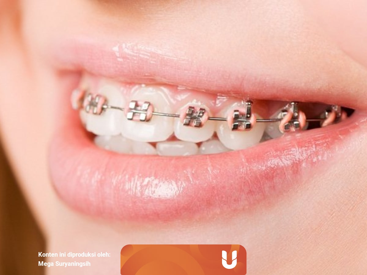 7 Hal Ini Cuma Dirasain Orang Yang Pakai Behel Kumparan Com