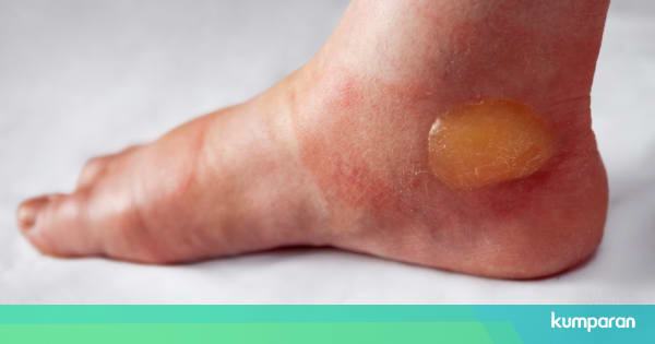 cerita alkitab anak balita Kaki Anak Balita Kena Knalpot Panas Harus Diobati dengan cerita alkitab anak balita Kaki Anak Balita Kena Knalpot Panas Harus Diobati dengan