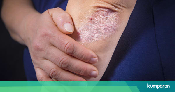 Mengenal Psoriasis, Penyakit Kulit Kronis yang Tidak Bisa ...