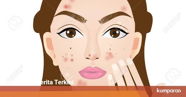 Cara Menghilangkan Bekas Jerawat Merah dan Menenangkan ...