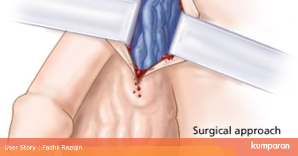Apa Olahraga Untuk Menyembuhkan Varikokel Kumparan Com