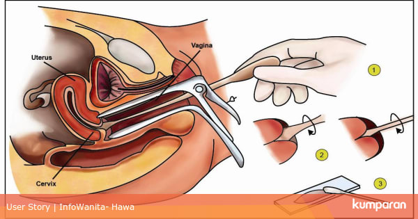 Penjelasan Soal Pap Smear Gratis Atau Berbayar Kumparan Com