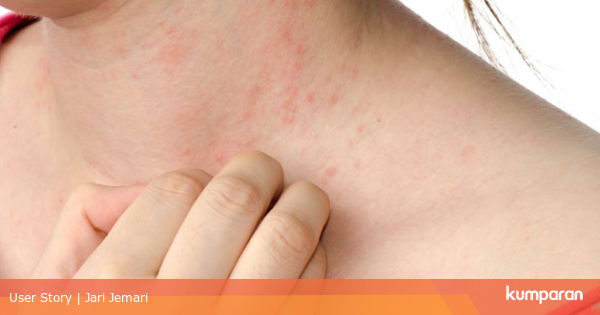Obat Tradisional Mujarab Rontokan Eksim Kering Dalam 5 Hari