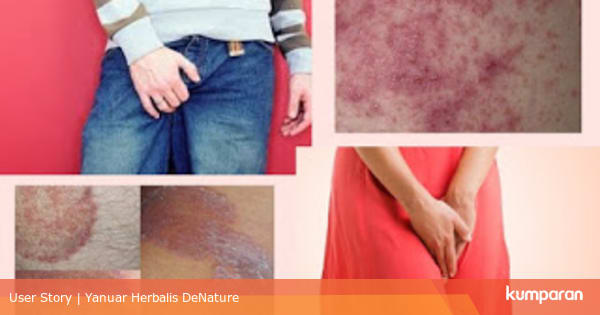 Cara Mengobati Penyakit Gatal Kulit Bintik Merah Di Selangkangan Kumparan Com