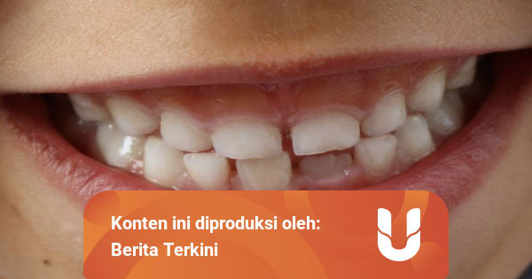 Arti Mimpi Gigi Copot Bagian Bawah Menurut Islam Primbon Dan Psikolog Kumparan Com