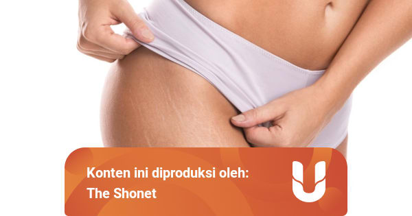 Stretch Marks Susah Hilang Atasi Saja Dengan Skincare Lokal Mengandung Kopi Ini Kumparan Com